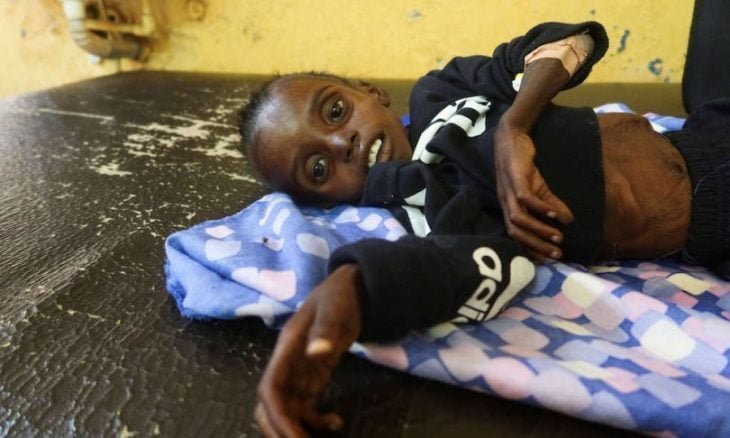 سوء التغذية يحصد أرواح 23 طفلا في كادوقلي والدلنج خلال شهر